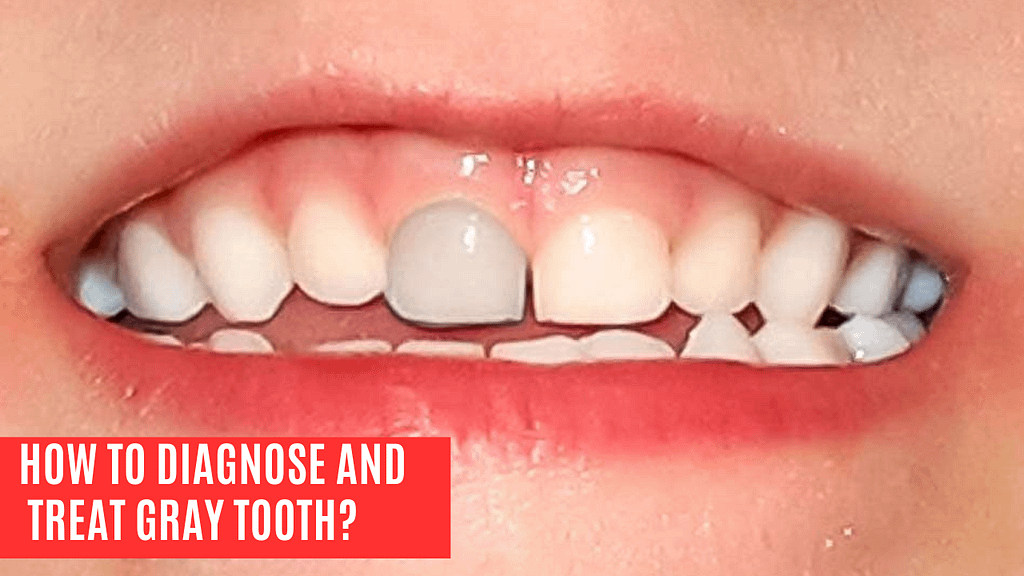 how to diagnose and treat Gray tooth