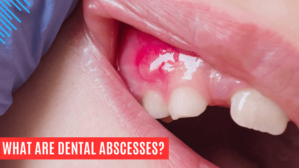 what are dental abscesses