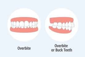 overbite vs. normal bite