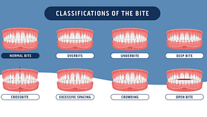 deep bite